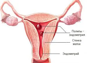 glandular diagnostic polip endometrial fibroasa si tratament (fibros) glandulară diagnostic polip endometrial fibroasa si tratament