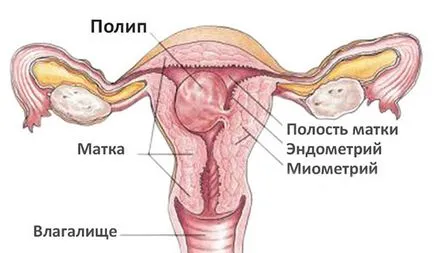 Fibroasa polip glandular endometrial, care este, cauzele tratamentului (polip glandular-fibroasă a endometrului) Fibroasă polip glandular endometrial, care este, cauzele, tratament