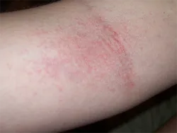 Un copil în coate ca o erupție cutanată