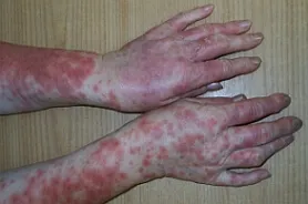 Alergia la soare că Alergia la soare că