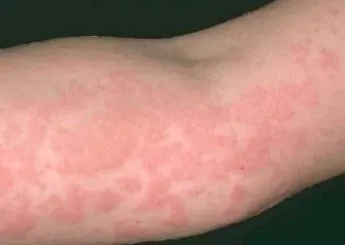 Alergia la soare că