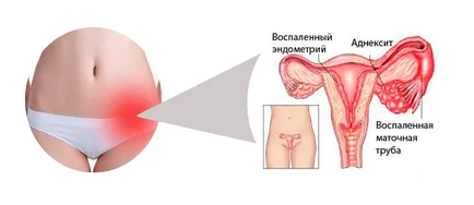 Tratamentul cu antibiotice adneksita Tratamentul cu antibiotice adneksita