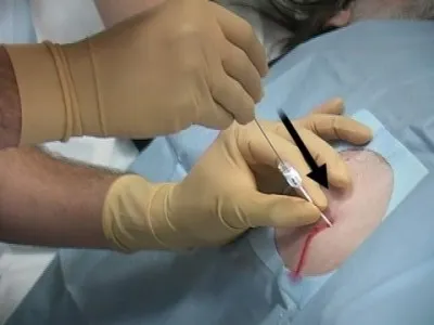 Din care fluidul în abdomen