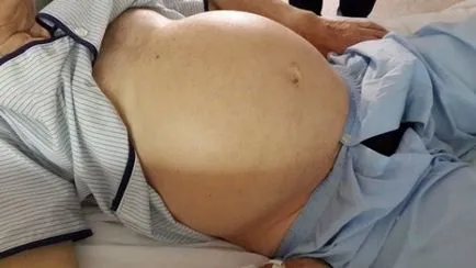 Din care fluidul în abdomen Din care fluidul în abdomen