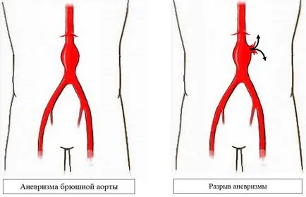 Ateroscleroza a aortei că este Ateroscleroza a aortei că este