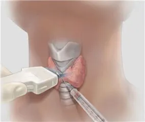 biopsie ac a glandei tiroide biopsie ac a glandei tiroide