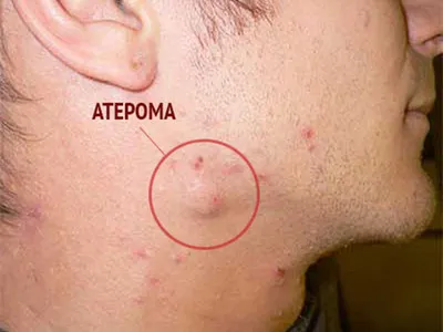 Ceea ce ar putea afecta în fălcile Ceea ce ar putea afecta în fălcile