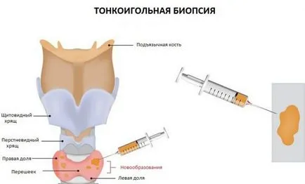 biopsie ac a glandei tiroide biopsie ac a glandei tiroide