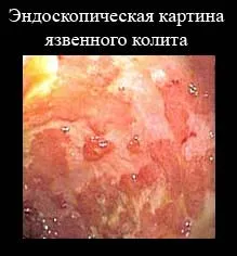 Colita ulcerativa simptome, tratament, prognostic
