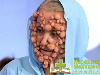 Neurofibromatoza - simptome, cauze, tratamentul neurofibromatoza, foto și video
