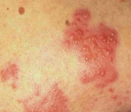 Toate ureaplasmosis tratament