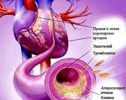 Ateroscleroza a aortei că este