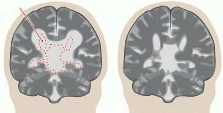 dilatarea ce