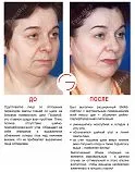 lifting facial ce