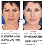 lifting facial ce
