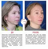 lifting facial ce