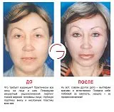 lifting facial ce