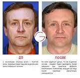 lifting facial ce