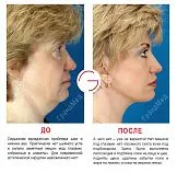 lifting facial ce