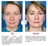 lifting facial ce