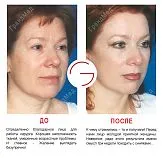 lifting facial ce