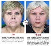 lifting facial ce