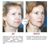lifting facial ce