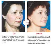 lifting facial ce