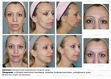 lifting facial ce