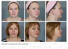 lifting facial ce