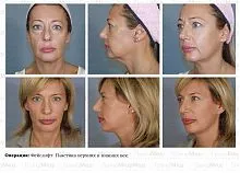 lifting facial ce