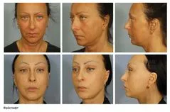 lifting facial ce