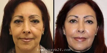lifting facial ce