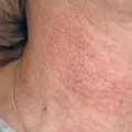 Herpes la bărbați și cum Herpes la bărbați și cum