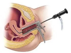 Hysteroresectoscopy ce este