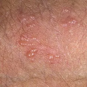 Herpes la bărbați și cum Herpes la bărbați și cum