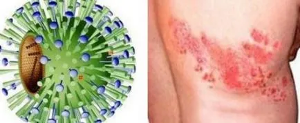 Tratamentul Herpes zoster