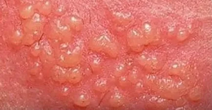 Herpes la bărbați și cum Herpes la bărbați și cum