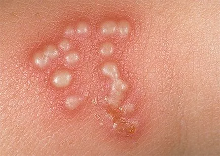 Herpes la bărbați și cum Herpes la bărbați și cum