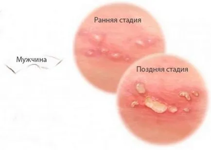 Herpes la bărbați și cum Herpes la bărbați și cum