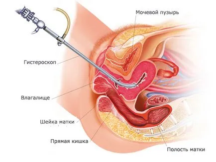 Hysteroresectoscopy ce este Hysteroresectoscopy ce este