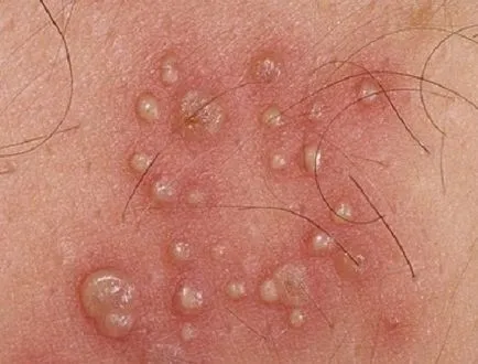 Herpes la bărbați și cum Herpes la bărbați și cum