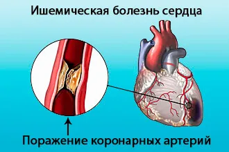 Cum de a trata ischemie