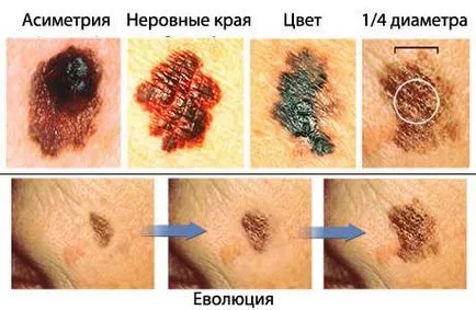 Birthmark sângerează care fac
