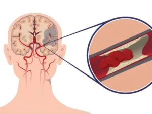 un al doilea accident vascular cerebral un al doilea accident vascular cerebral