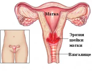 Cum pot trata eroziunea