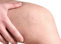 Cum sa scapi de asteriscuri vasculare