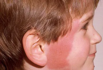 infecție streptococică la copii infecție streptococică la copii