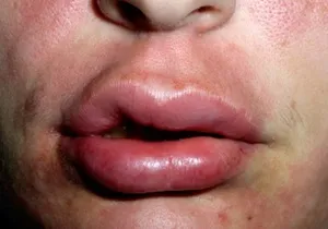 buza îngroșată, care poate fi o cauză decât pentru a ajuta pentru a scăpa de umflare de pe fața lui (umflarea buzei este capabil de a fi cauza unei persoane) buza îngroșată, care poate fi o cauză decât pentru a ajuta pentru a scăpa de umflare pe fața lui