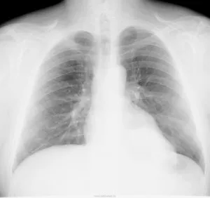 Tumorile simptomelor superior și posterior mediastin, clasificare, cauze, prognosticul și tratamentul